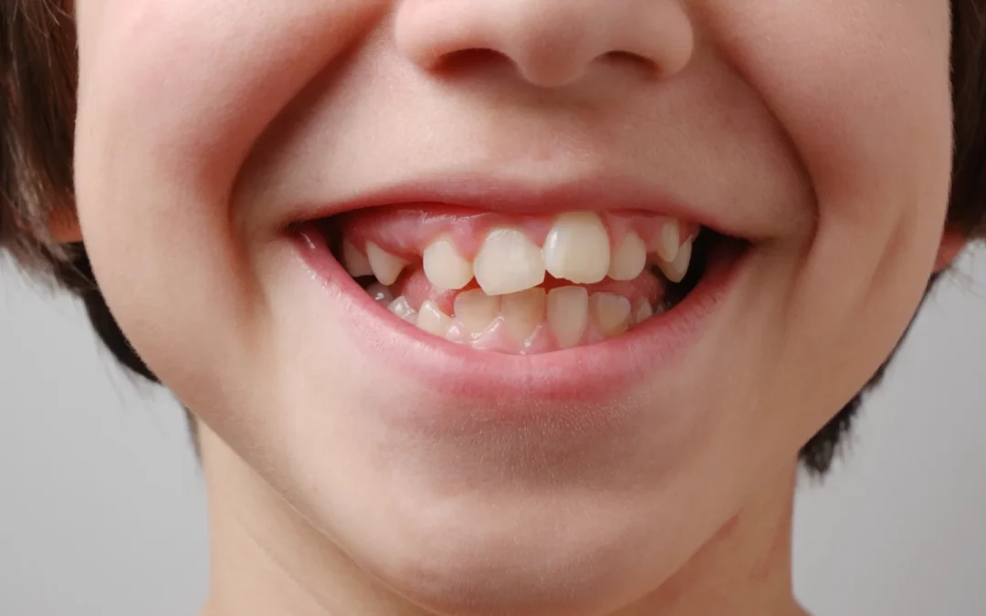 Palatine expanders: what are they used for and when to use them?