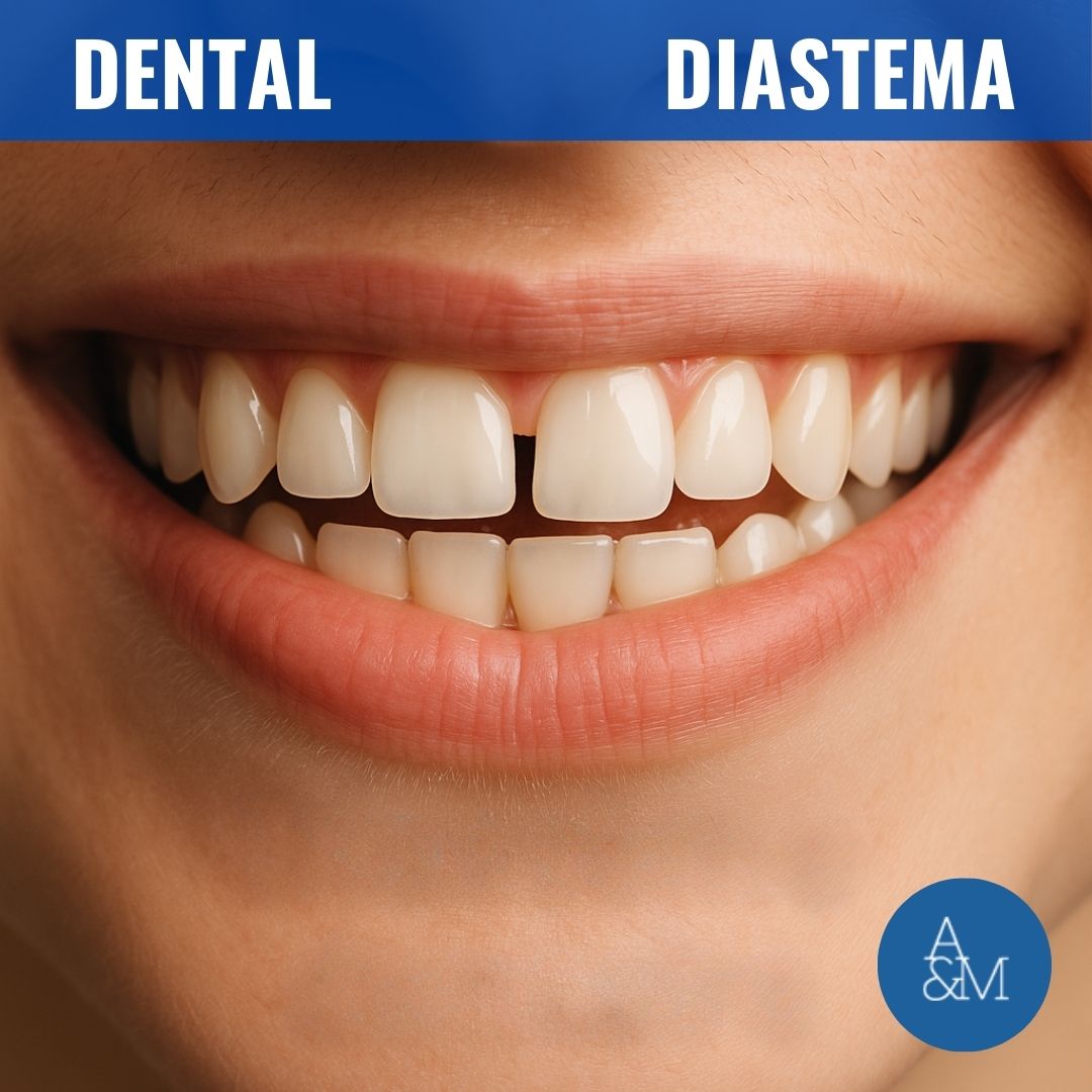 Diasteme dentaire Dental Diastema Diastème dentaire